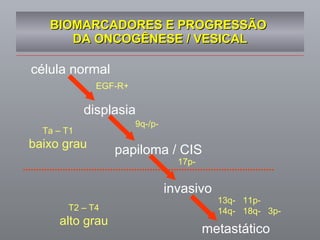 BIOMARCADORES E PROGRESSÃO  DA ONCOGÊNESE / VESICAL célula normal displasia papiloma / CIS invasivo metastático EGF-R+ 9q-/p- 17p- 13q-  11p- 14q-  18q-  3p- T2 – T4 alto grau Ta – T1 baixo grau 