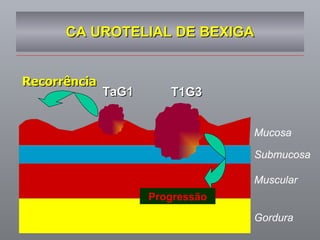 CA UROTELIAL DE BEXIGA TaG1 T1G3 Mucosa Submucosa Muscular Gordura Progressão Recorrência  