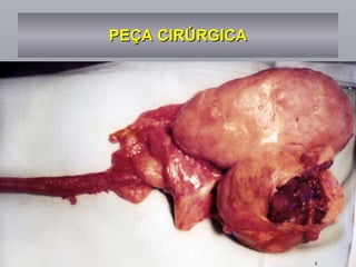 PEÇA CIRÚRGICA 