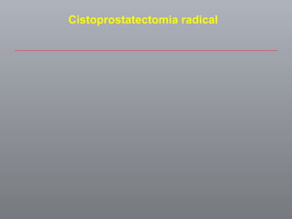 Cistoprostatectomia radical 