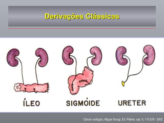 Derivações Clássicas Câncer urológico, Miguel Srougi, Ed. Platina, cap. 9, 173-278 - 2002 