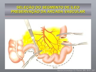 SELEÇÃO DO SEGMENTO DE ÍLEO PRESERVAÇÃO DA ARCADA VASCULAR Atlas de Uro-oncologia, Ed. Plamark, SBU, 89-91, 2007 