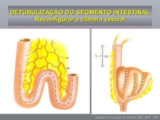 DETUBULIZAÇÃO DO SEGMENTO INTESTINAL Reconfigurar a câmara vesical Atlas de Uro-oncologia, Ed. Plamark, SBU, 89-91, 2007 
