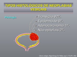 TIPOS HISTOLÓGICOS DE NEOPLASIAS VESICAIS Transição 92% Epidermóide 6% Adenocarcinoma 1% Não-epiteliais 2% Patologia Câncer urológico, Miguel Srougi, Ed. Platina, cap. 9, 173-278 - 2002 