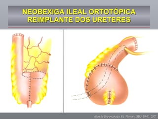 NEOBEXIGA ILEAL ORTOTÓPICA REIMPLANTE DOS URETERES Atlas de Uro-oncologia, Ed. Plamark, SBU, 89-91, 2007 