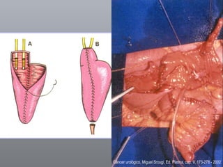 Câncer urológico, Miguel Srougi, Ed. Platina, cap. 9, 173-278 - 2002 