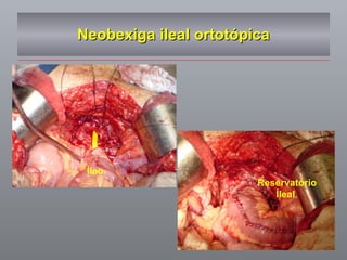 Neobexiga ileal ortotópica Íleo Reservatório Íleal 