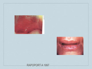 RAPOPORT A 1997
 