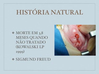 HISTÓRIA NATURAL


❖   MORTE EM 3,8
    MESES QUANDO
    NÃO TRATADO
    (KOWALSKI LP
    1999)
❖   SIGMUND FREUD
 