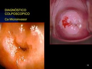Limitación: tasa elevada de falsos negativos >50%.