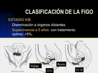 25/11/200931CLASIFICACIÓN DE LA FIGOESTADIO 0Carcinoma in situ, NIC III.