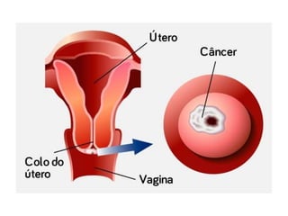 Câncer de cólo de útero