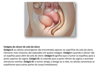 Estágios do câncer de colo do útero
Estágio 0: as células cancerígenas são encontradas apenas na superfície do colo do útero.
Cânceres mais invasivos são separados em quatro estágios. Estágio I: quando o câncer não
se espalhou para além do colo do útero. Estágio II significa que o tumor se espalhou para a
parte superior da vagina. Estágio III: se estende para a parte inferior da vagina e acomete
estruturas vizinhas. Estágio IV: o tumor atingiu a bexiga ou o reto, ou células cancerosas se
espalharam para outras partes do corpo (metástases).
 