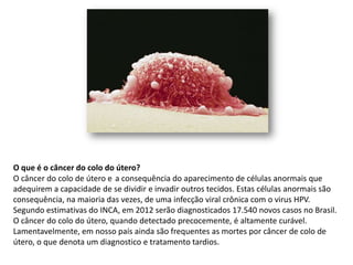 O que é o câncer do colo do útero?
O câncer do colo de útero e a consequência do aparecimento de células anormais que
adequirem a capacidade de se dividir e invadir outros tecidos. Estas células anormais são
consequência, na maioria das vezes, de uma infecção viral crônica com o virus HPV.
Segundo estimativas do INCA, em 2012 serão diagnosticados 17.540 novos casos no Brasil.
O câncer do colo do útero, quando detectado precocemente, é altamente curável.
Lamentavelmente, em nosso país ainda são frequentes as mortes por câncer de colo de
útero, o que denota um diagnostico e tratamento tardios.
 