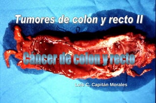 Luis C. Capitán Morales Tumores de colon y recto II Cáncer de colon y recto 
