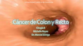 CáncerdeColonyRecto
Cirugía II
Michelle Reyes
Dr. Marcial Zúniga
Universidad Católica de Honduras
 