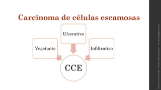 Carcinoma de células escamosas
CCE
Vegetante
Ulcerativo
Infiltrativo
carolinereisg@gmail.comCâncerdeColouterino–CarolineReisGonçalves
 