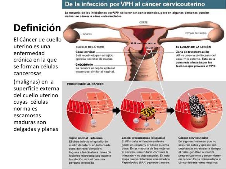 CANCER EPIDERMOIDE INFILTRANTE DEL CUELLO UTERINO. DR