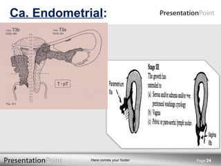 Ca. Endometrial : Page  