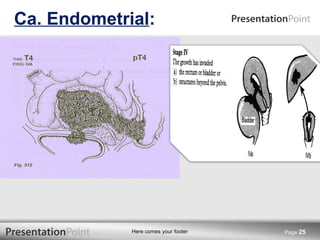 Ca. Endometrial : Page  