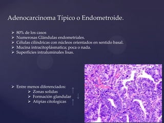 Adenocarcinoma Típico o Endometroide.






80% de los casos
Numerosas Glándulas endometriales.
Células cilíndricas con núcleos orientados en sentido basal.
Mucina intracitoplásmatica; poca o nada.
Superficies intraluminales lisas.

 Entre menos diferenciados:
 Zonas solidas
 Formación glandular
 Atipias citologicas

 