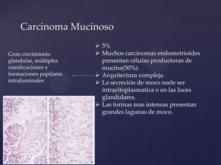 Carcinoma Mucinoso
Gran crecimiento
glandular, múltiples
ramificaciones y
formaciones papilares
intraluminales

 5%
 Muchos carcinomas endometrioides
presentan células productoras de
mucina(50%).
 Arquitectura compleja.
 La secreción de moco suele ser
intracitoplasmatica o en las luces
glandulares.
 Las formas mas intensas presentan
grandes lagunas de moco.

 