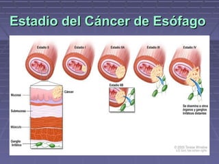 Estadio del Cáncer de Esófago
 
