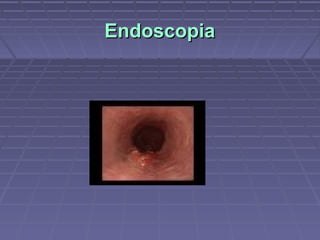 Endoscopia
 