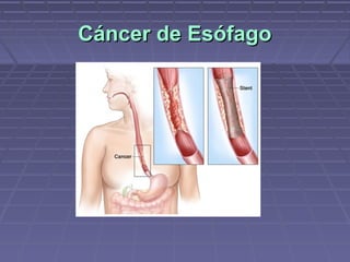 Cáncer de Esófago
 