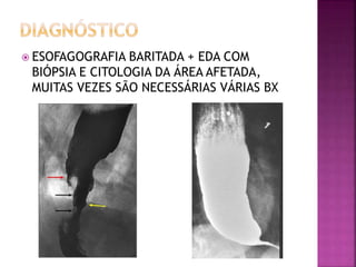  ESOFAGOGRAFIA BARITADA + EDA COM
BIÓPSIA E CITOLOGIA DA ÁREA AFETADA,
MUITAS VEZES SÃO NECESSÁRIAS VÁRIAS BX
 