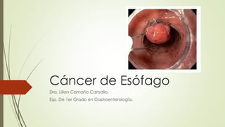 Cáncer de Esófago
Dra. Lilian Camaño Carballo.
Esp. De 1er Grado en Gastroenterología.
 