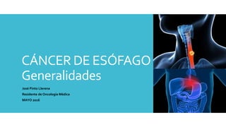 CÁNCER DE ESÓFAGO
Generalidades
José Pinto Llerena
Residente de Oncología Médica
MAYO 2016
 