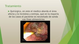 Tratamiento
 Quirúrgico, en este el medico aborda el área
afecta y lo incisióna y extirpa, que en la mayoría
de los casos el paciente es necesitado de sonda
con fines alimenticios
 