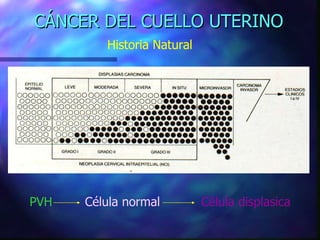 CÁNCER DEL CUELLO UTERINO Historia Natural PVH   Célula normal     Célula displasica 