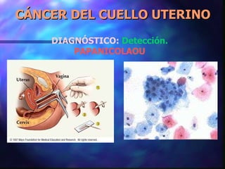 CÁNCER DEL CUELLO UTERINO DIAGNÓSTICO:   Detección.  PAPANICOLAOU 