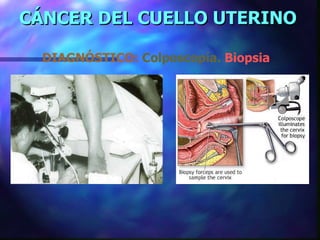 CÁNCER DEL CUELLO UTERINO DIAGNÓSTICO:   Colposcopía.  Biopsia 