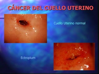 CÁNCER DEL CUELLO UTERINO Cuello Uterino normal Ectropium 