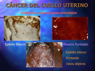 CÁNCER DEL CUELLO UTERINO Imágenes colposcópicas anormales Epitelio Blanco Mosaico Punteado Epitelio blanco Punteado  Vasos atípicos 