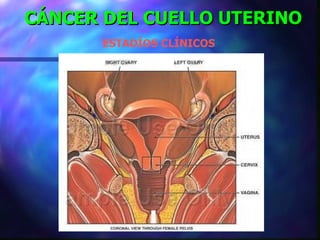 CÁNCER DEL CUELLO UTERINO ESTADÍOS CLÍNICOS 