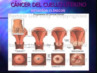 CÁNCER DEL CUELLO UTERINO ESTADÍOS CLÍNICOS 