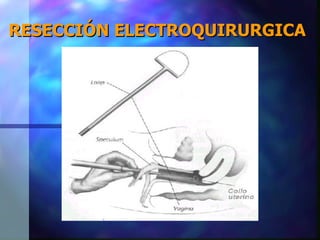 RESECCIÓN ELECTROQUIRURGICA 