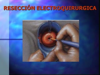 RESECCIÓN ELECTROQUIRURGICA 