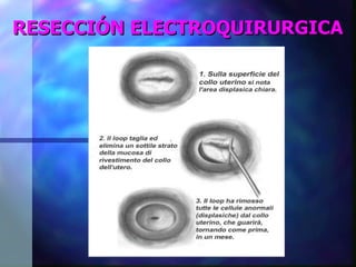RESECCIÓN ELECTROQUIRURGICA 