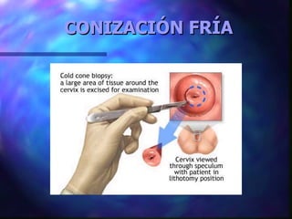 CONIZACIÓN FRÍA 