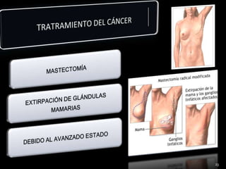 TRATRAMIENTO DEL CÁNCER23