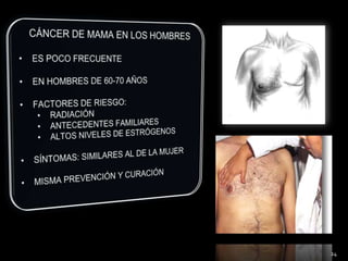 CÁNCER DE MAMA EN LOS HOMBRESES POCO FRECUENTE