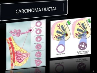 CARCINOMA DUCTAL 5