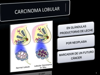 CARCINOMA LOBULAR 6
