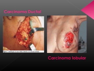 Carcinoma lobular
 