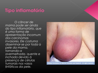 O câncer de
mama pode ser ainda
do tipo inflamatório, que
é uma forma de
apresentação incomum
dos carcinomas
invasores. Ele costuma
disseminar-se por toda a
pele da mama,
tornando-a
avermelhada, quente e
inchada devido à
presença de células
tumorais nos vasos
linfáticos da pele.
 